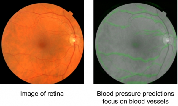 谷歌AI可以通过眼部扫描预测心脏疾病风险
