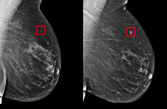 MIT 人工智能系统助女性提早五年识别乳癌徵状